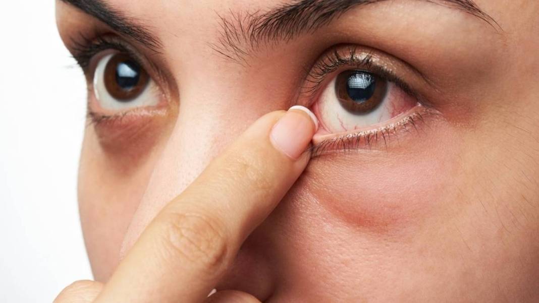 Bahar günlerinde gözünüzden olabilirsiniz! Bu belirtilere dikkat: Önce görme bozukluğuyla başlıyor 5